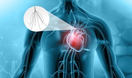 IVC-Filter-litigation